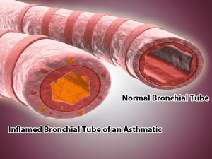 A molecular salt that combines the anti-inflammatory drug oxaprozin and the asthma drug salbutamol could improve asthma therapies by slowing the release of salbutamol into the body while treating inflammation of the airways.