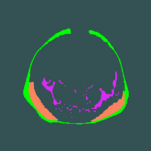 The superficial subcutaneous tissue (green), the deep subcutaneous tissue (orange), and the internal adipose tissue (magenta) of Singaporean infants of three different ethnic backgrounds were measured and compared.
