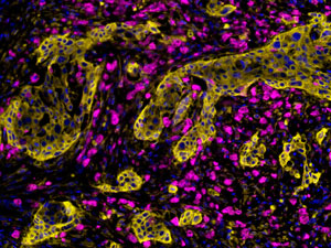Large numbers of macrophages (stained pink) are found in pancreatic tumors (stained yellow).