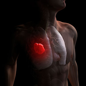 Checking for specific fatty acids in a pleural effusion sample could provide an additional test that will help validate a diagnosis of lung cancer, especially when there aren't enough cells in the lung biopsy samples.