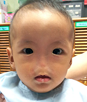 A young patient with Bosma arhinia microphthalmia syndrome (BAMS).