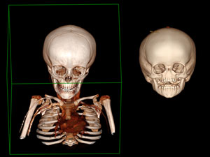CT scans of the cranium of a control (left) and BAMS (right) patient.