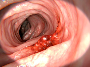 Computer-generated imagery of an abnormal growth in the colon. A*STAR scientists have now provided compelling evidence that metformin might be a useful clinical agent to treat such life-threatening malignancies.