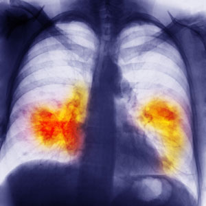 A*STAR researchers have developed an RNA-based anticancer therapy that targets a metabolic pathway in tumor-initiating cells.