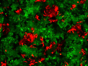 The expression of different proteins stained in red and green indicates the variation in the make-up of a patient-derived model of a tumor. Such models can be used to determine the most effective treatment for individual patients.