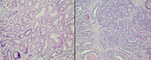 Genetic sequencing of gastric samples from people with intestinal metaplasia (left) could help identify those who are more at-risk of developing gastric cancer (right).