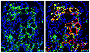 Clumps of distal airway stem cells (green) assemble at the site of lung injury and express alveolar marker (red)