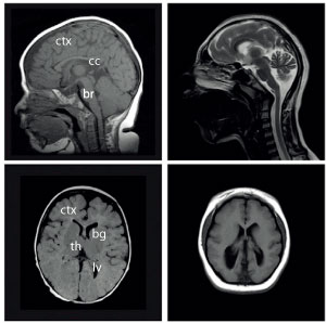 Magnetic resonance imaging scans of normal (left) and microcephalic (right) brains.